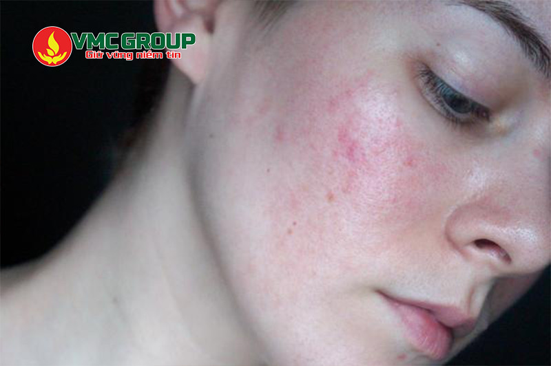 Lạm dụng Axit lauric trong mỹ phẩm có thể gây kích ứng da